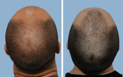 Before and After